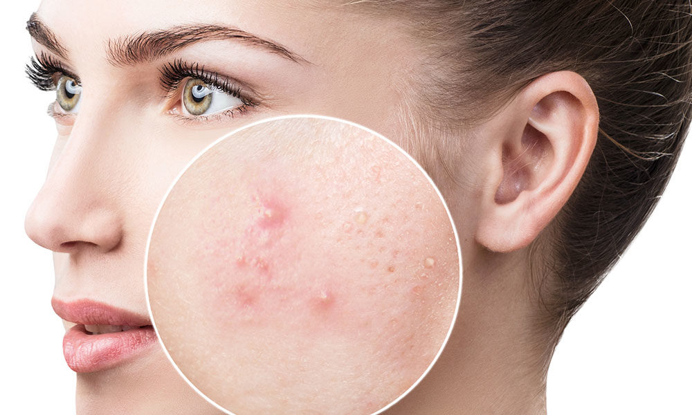 Cum poti scapa mai usor de acnee
